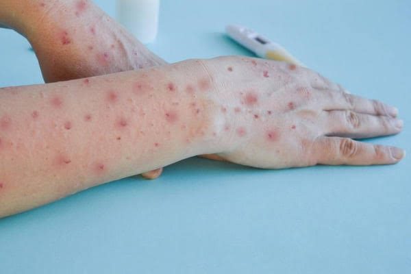 Rio de Janeiro Registra Mais de 1.200 Casos Confirmados de Mpox