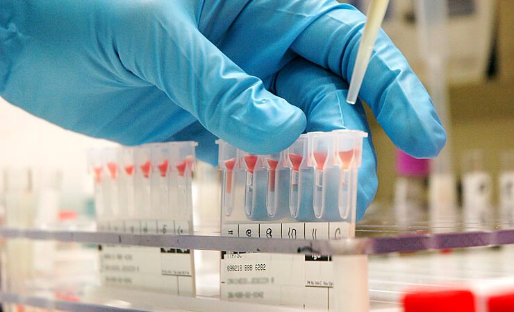 Seis pacientes que fizeram transplante foram infectados por HIV no RJ